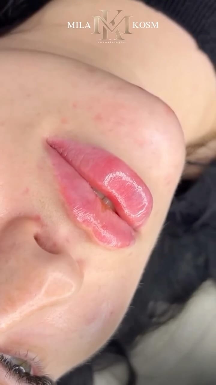 Post 5 by Dr. Mila 💉 work in USA 🇺🇸 Turkey 🇹🇷 Russia 🇷🇺 on Instagram (video)