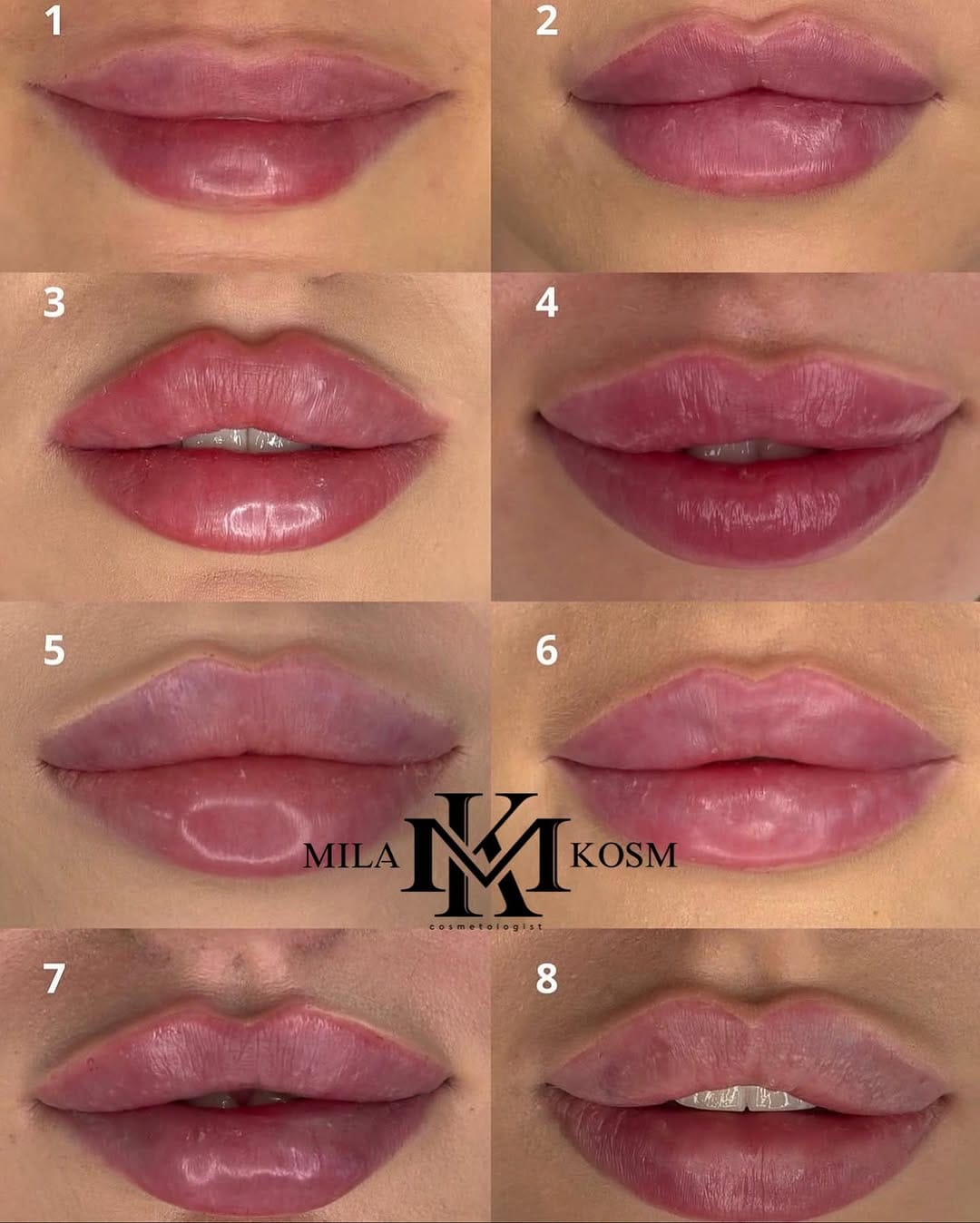Post 4 by Dr. Mila 💉 work in USA 🇺🇸 Turkey 🇹🇷 Russia 🇷🇺 on Instagram (image)