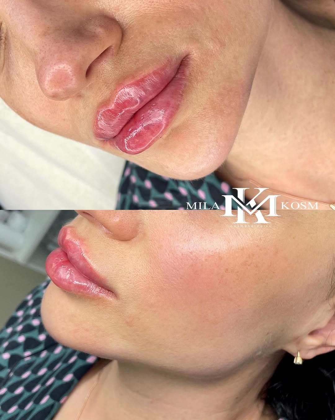 Post 6 by Dr. Mila 💉 work in USA 🇺🇸 Turkey 🇹🇷 Russia 🇷🇺 on Instagram (carousel)
