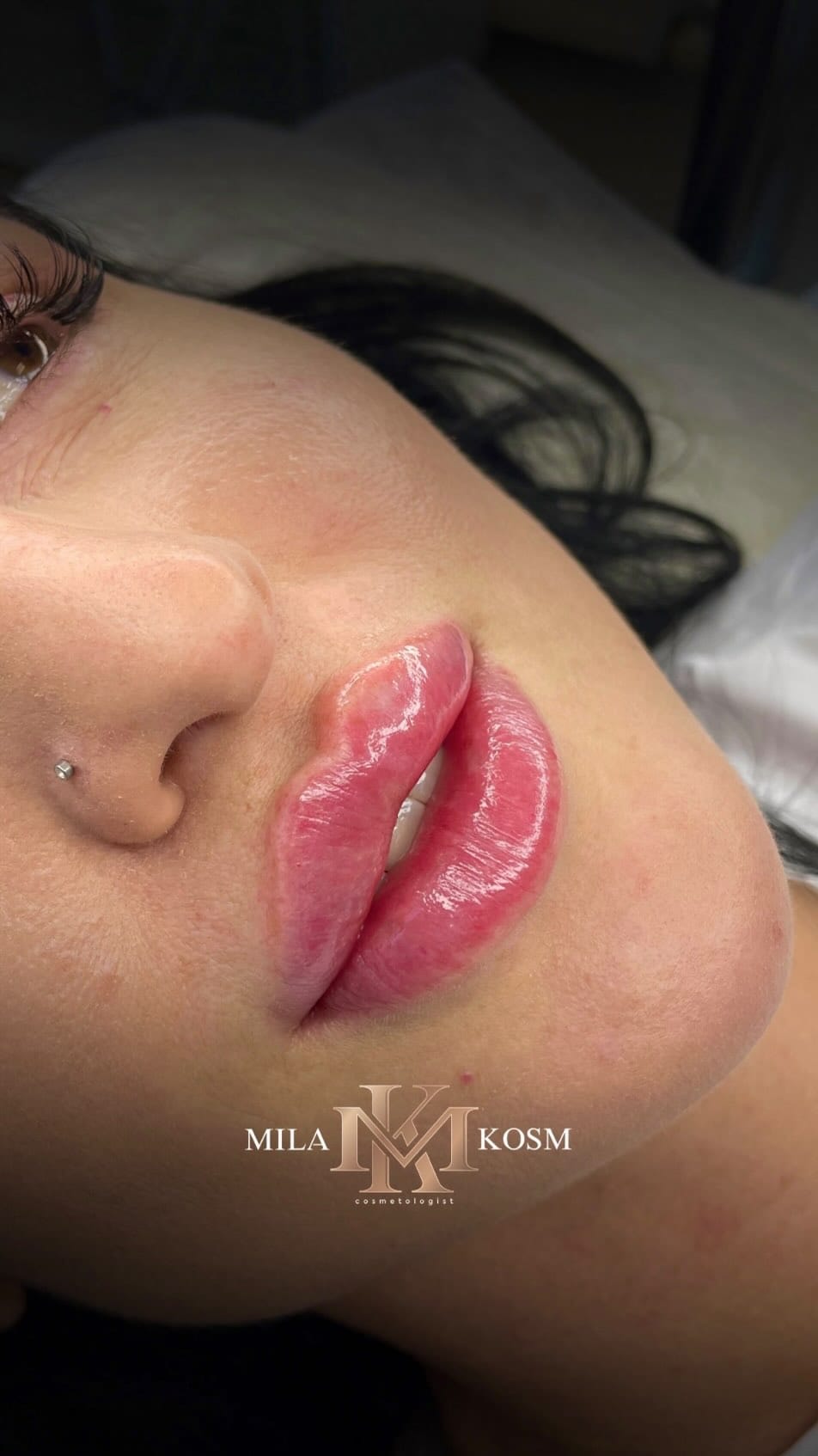 Post 3 by Dr. Mila 💉 work in USA 🇺🇸 Turkey 🇹🇷 Russia 🇷🇺 on Instagram (video)