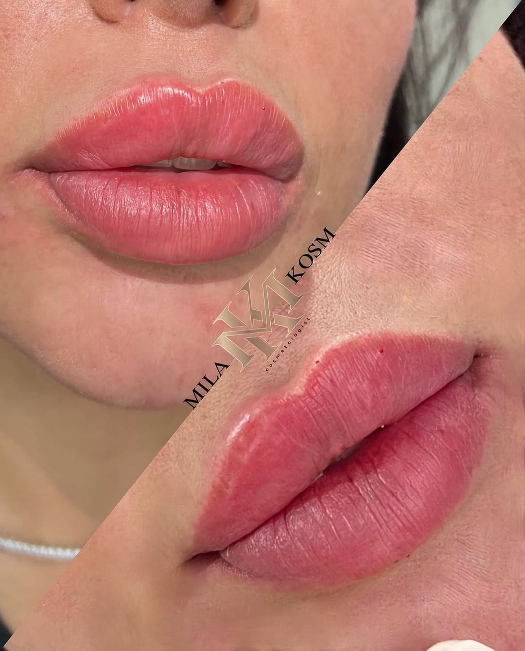 Post 2 by Dr. Mila 💉 work in USA 🇺🇸 Turkey 🇹🇷 Russia 🇷🇺 on Instagram (carousel)