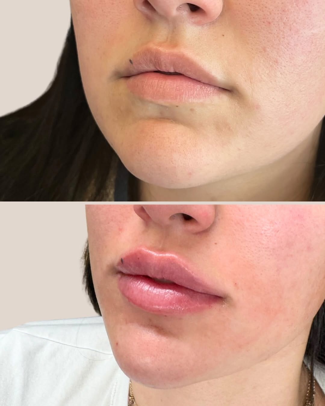 Post 6 by NEEKAN RIVERA | Expert Injector+AllerganTrainer on Instagram (carousel)