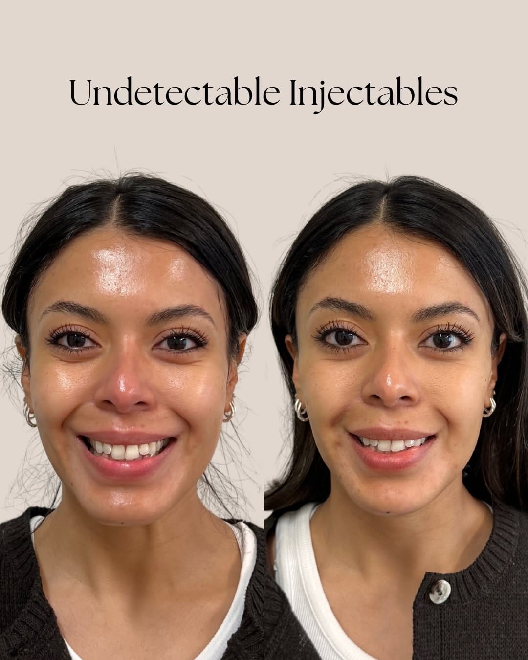 Post 9 by NEEKAN RIVERA | Expert Injector+AllerganTrainer on Instagram (carousel)