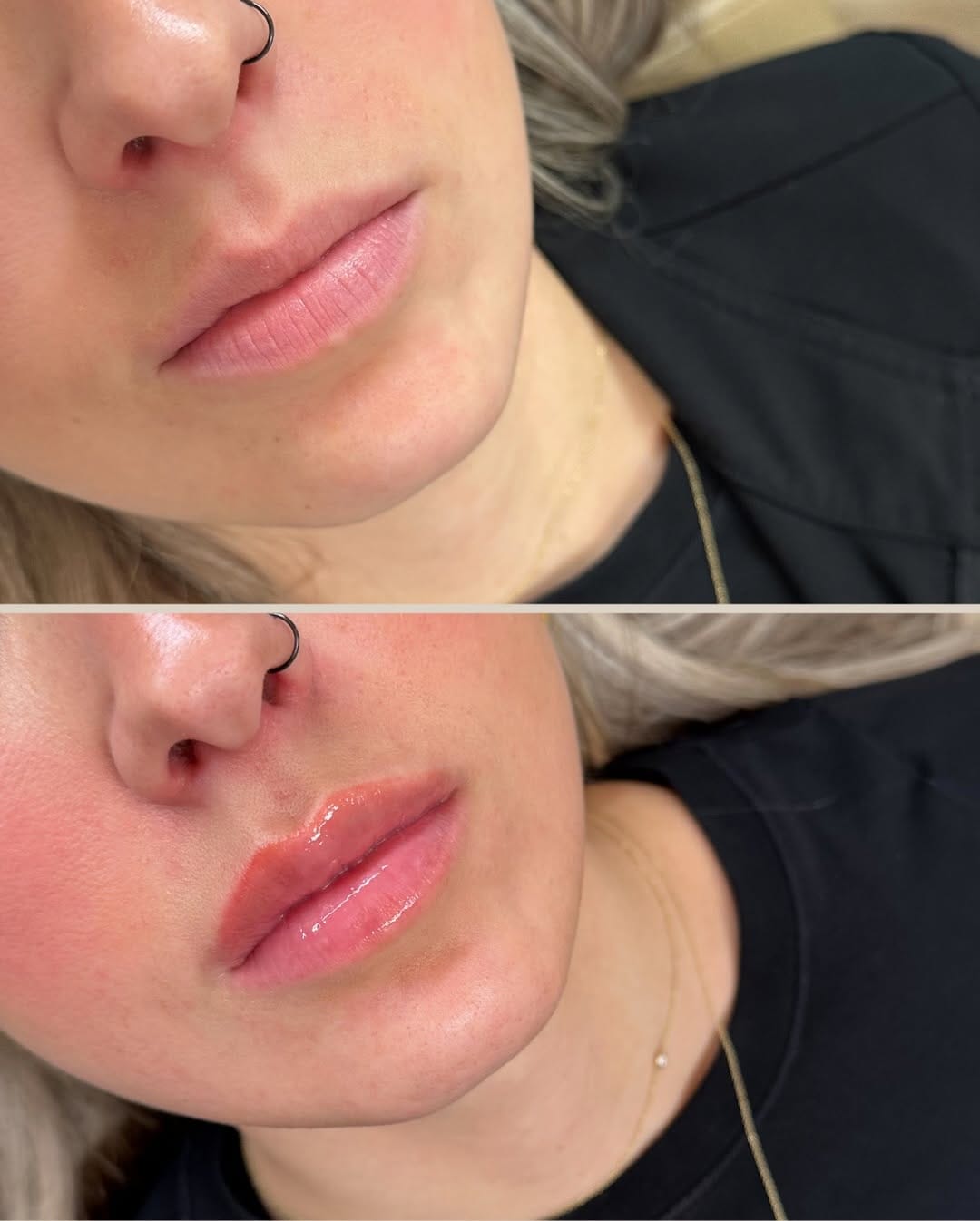 Post 4 by NEEKAN RIVERA | Expert Injector+AllerganTrainer on Instagram (carousel)