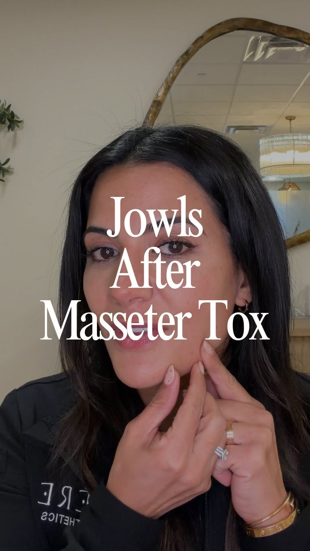 Post 2 by NEEKAN RIVERA | Expert Injector+AllerganTrainer on Instagram (video)