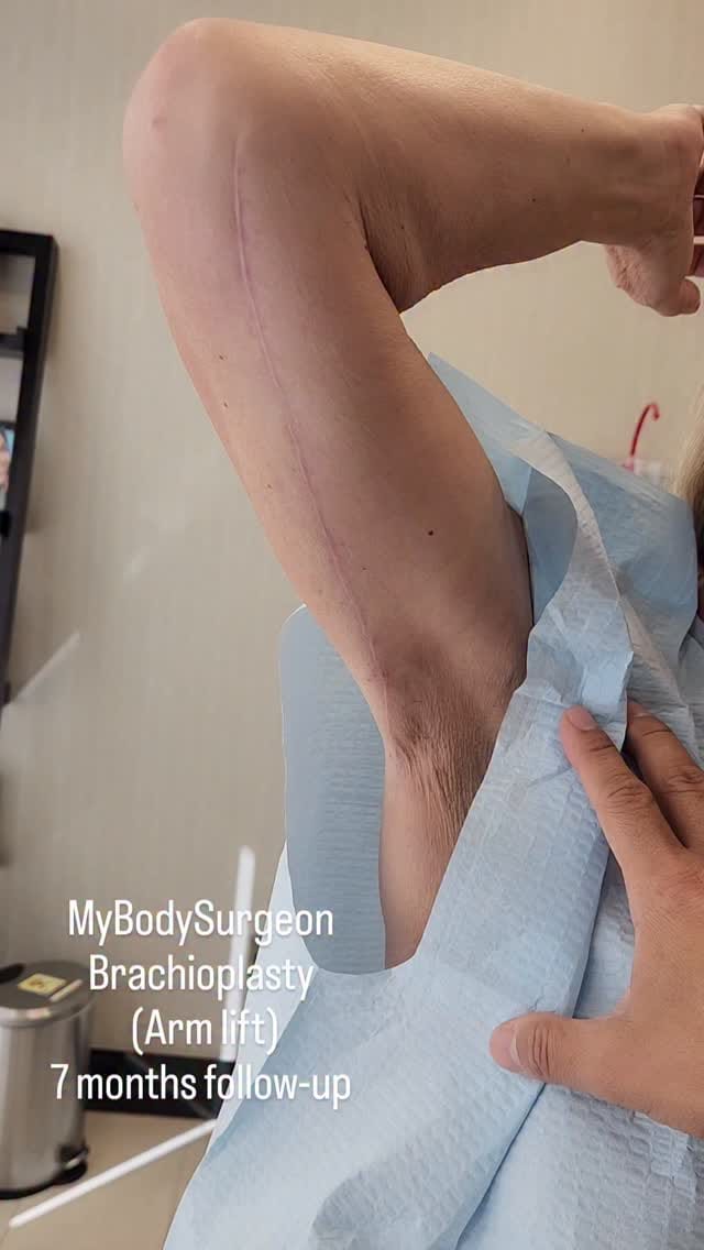 Post 3 by Sugar Land Plastic Surgery / MyBodySurgeon / MyBodySurgeon_htx on Instagram (video)