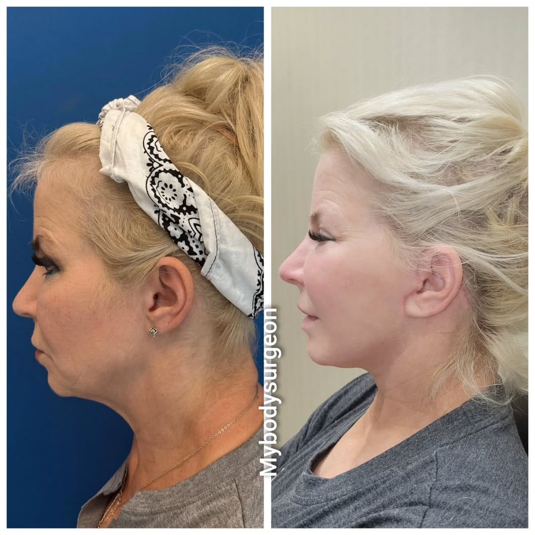 Post 10 by Sugar Land Plastic Surgery / MyBodySurgeon / MyBodySurgeon_htx on Instagram (carousel)