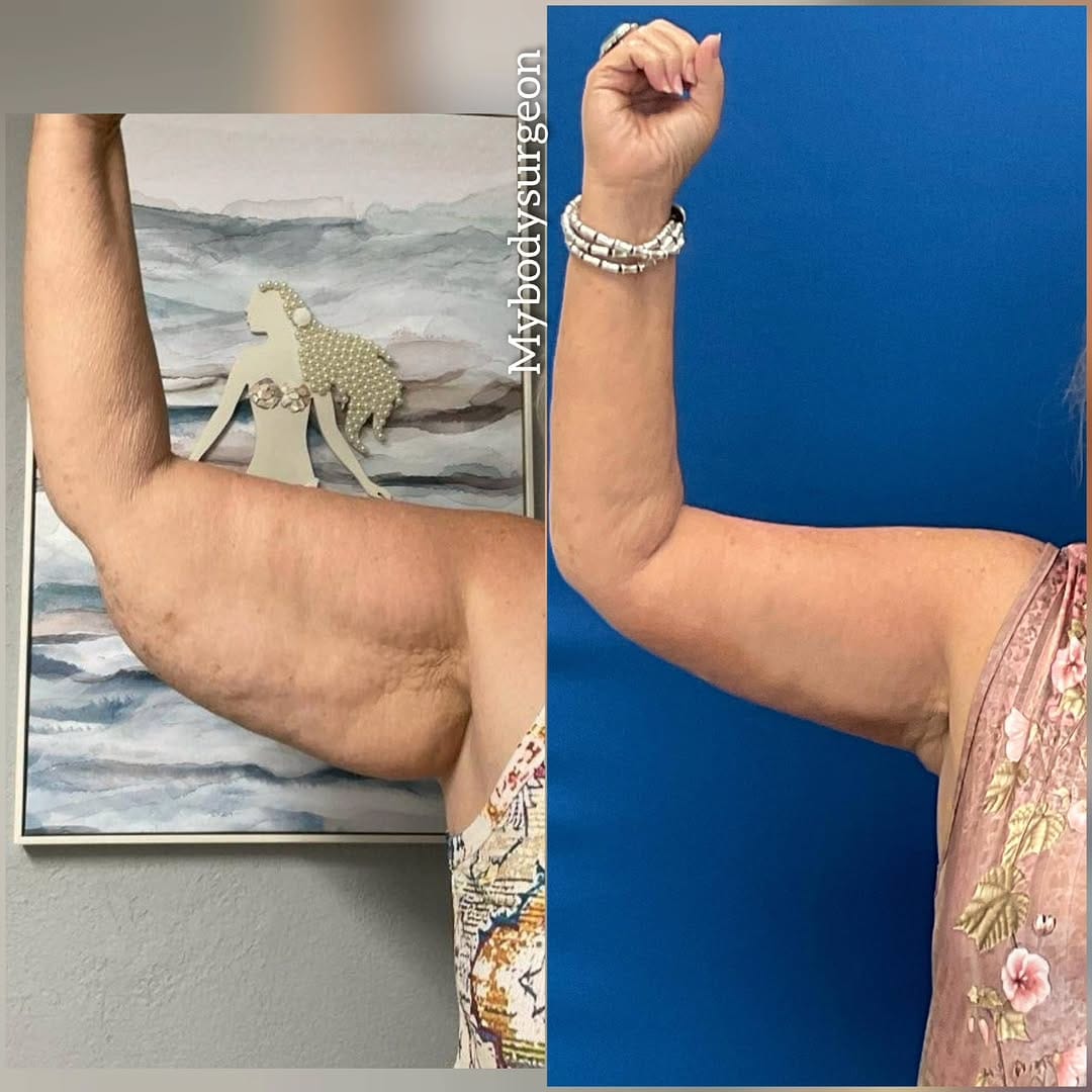 Post 6 by Sugar Land Plastic Surgery / MyBodySurgeon / MyBodySurgeon_htx on Instagram (carousel)