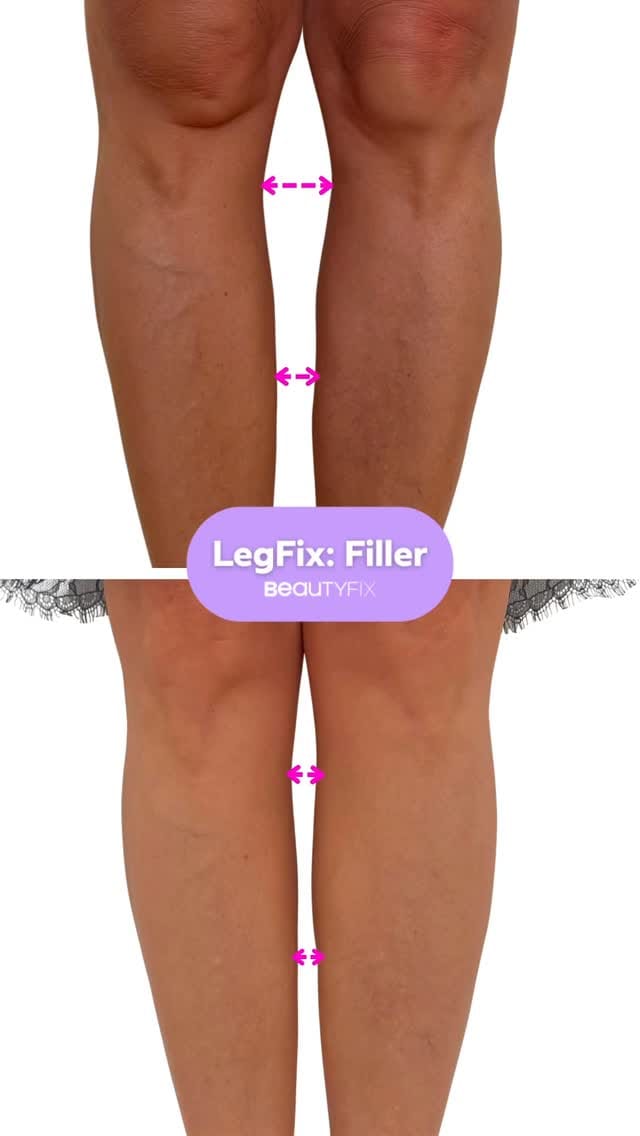 Post 7 by BeautyFix MedSpa on Instagram (video)