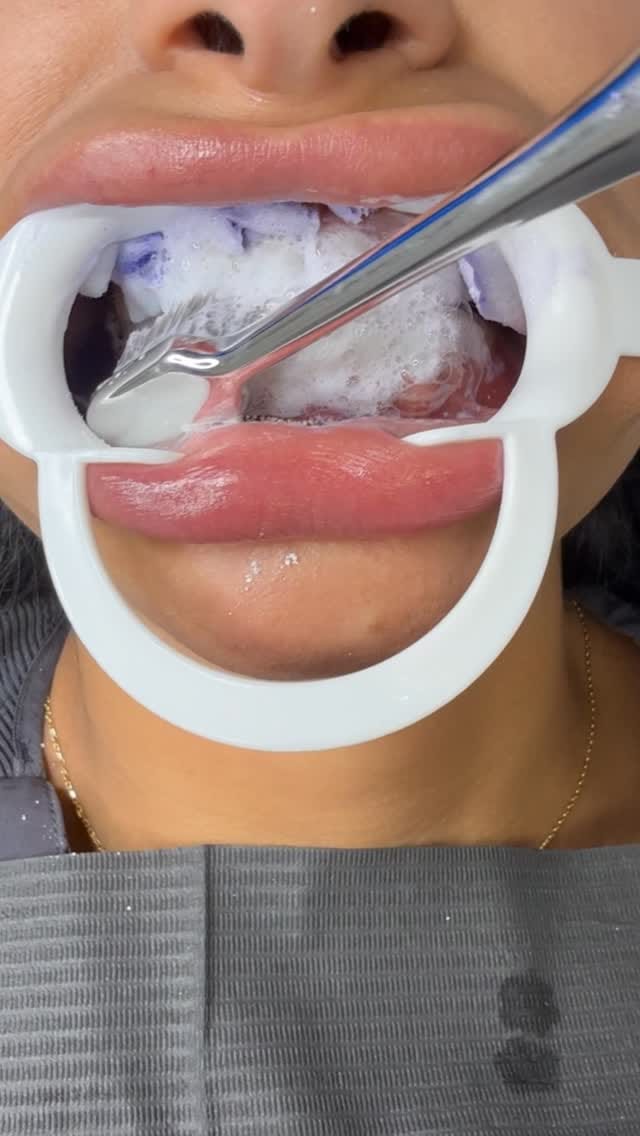 Post 7 by LaserGlow™ Teeth Whitening on Instagram (video)