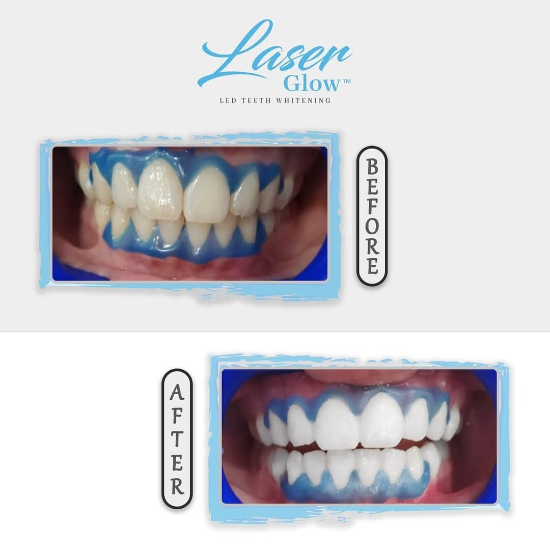 Post 10 by LaserGlow™ Teeth Whitening on Instagram (image)