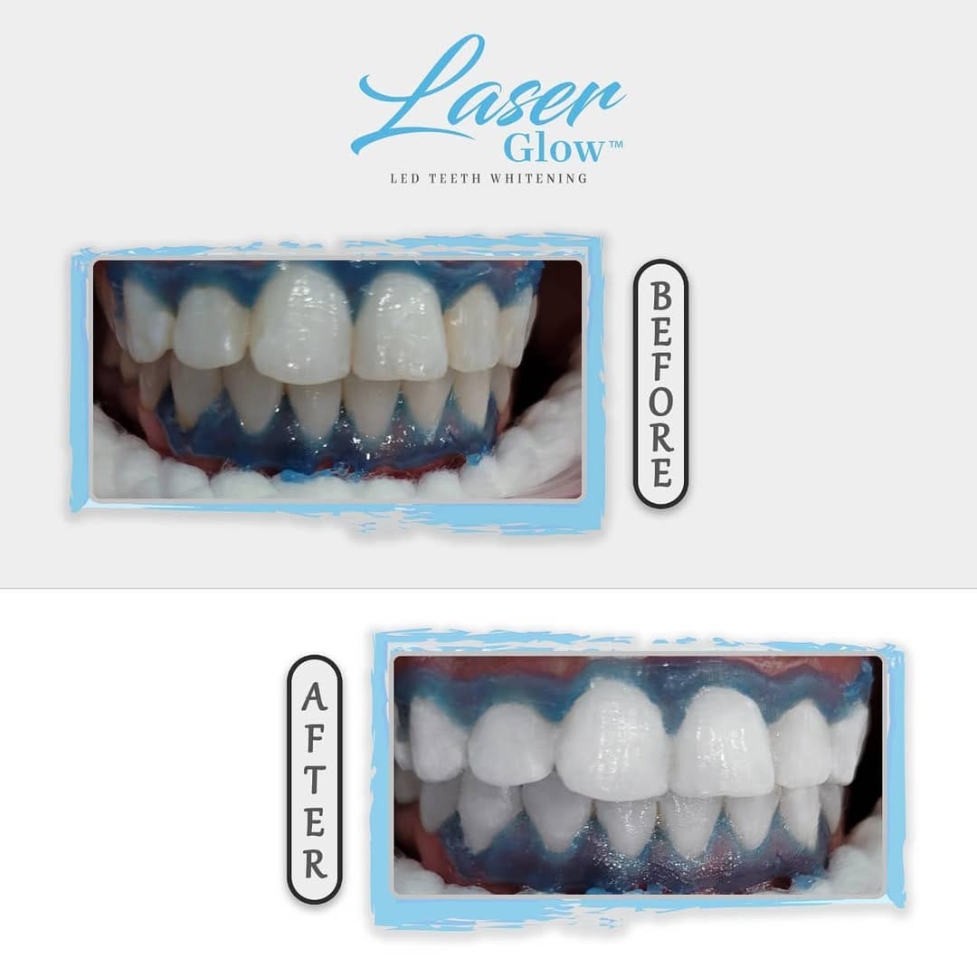 Post 9 by LaserGlow™ Teeth Whitening on Instagram (image)