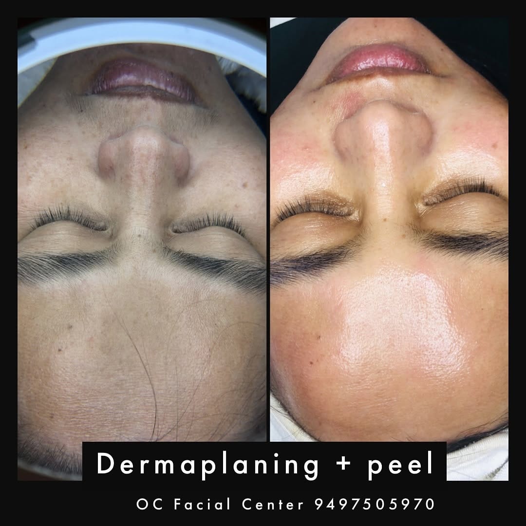 Post 10 by OC Facial Center on Instagram (image)