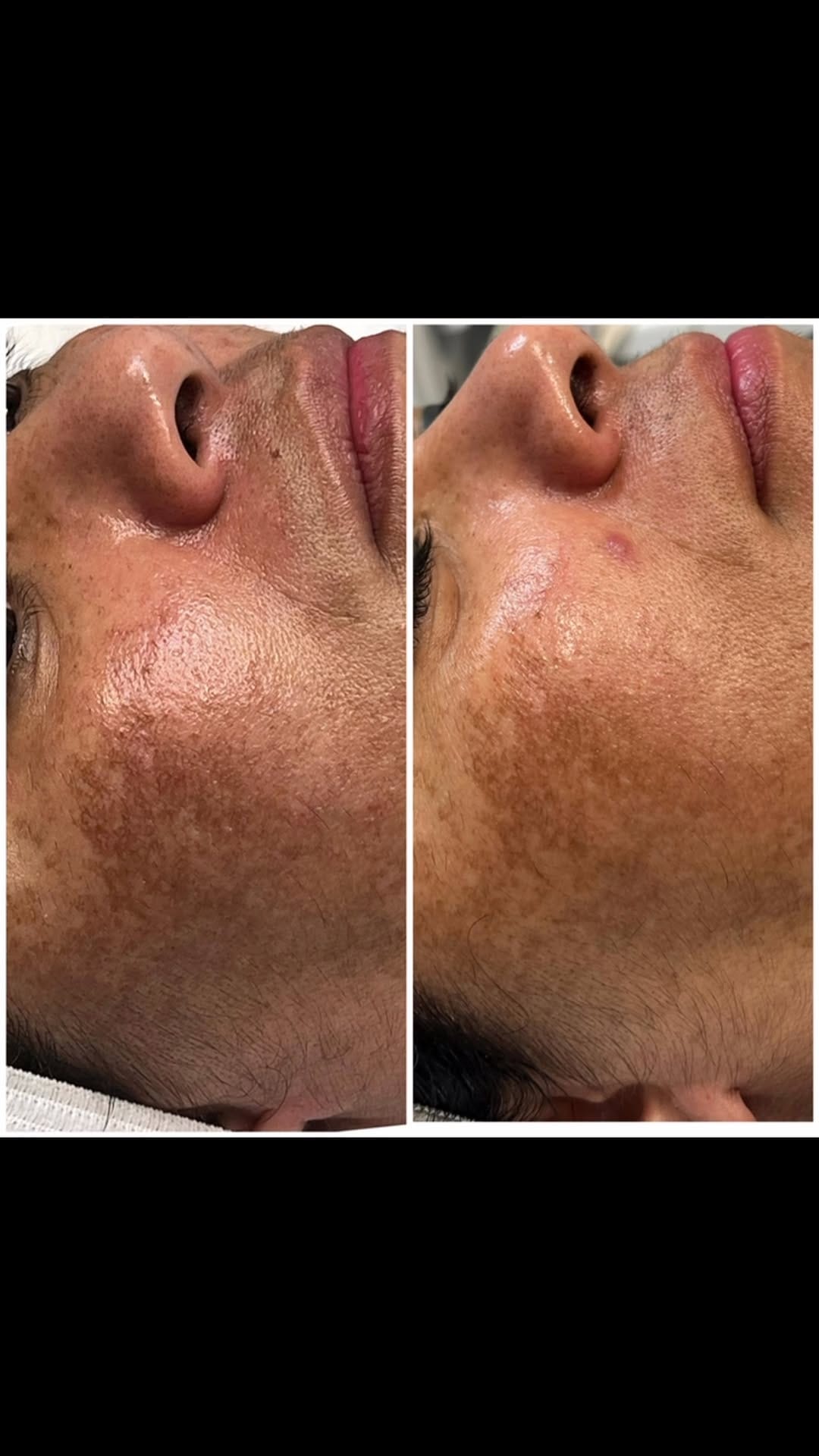 Post 5 by Flawless Skin Studio on Instagram (video)