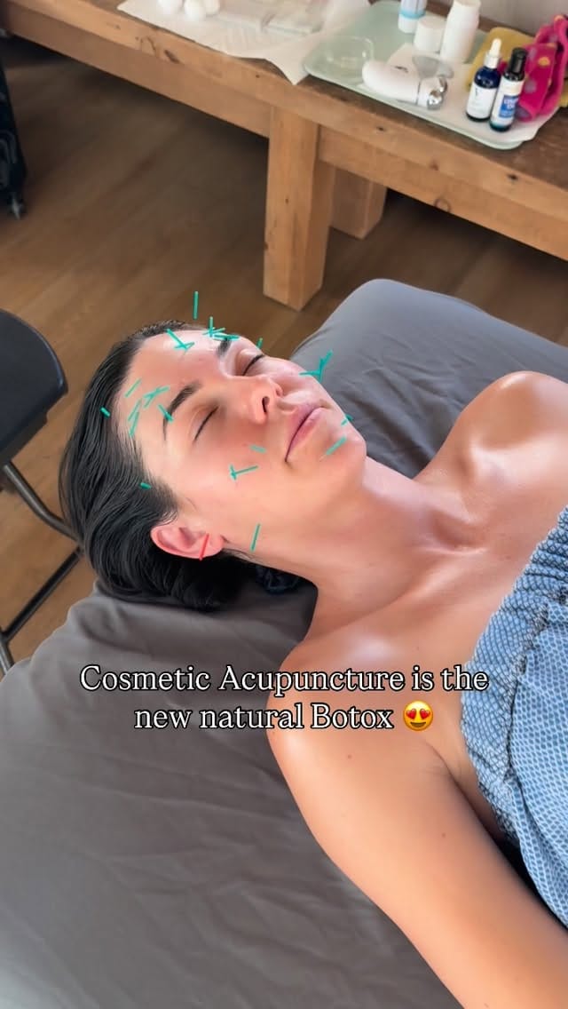 Post 1 by California Mobile Acupuncture on Instagram (video)