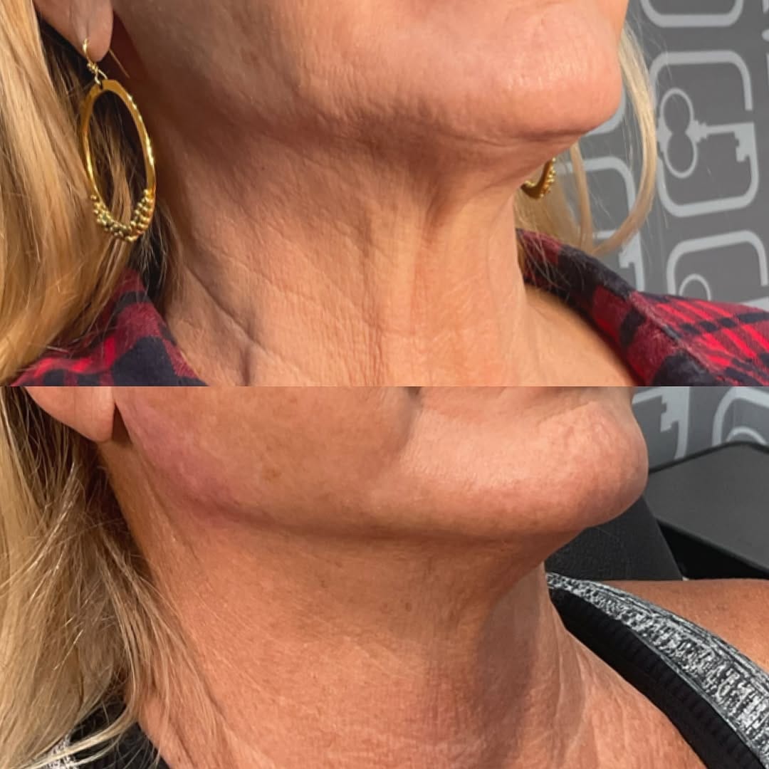Post 4 by DALLAS INJECTOR ✮ Alisha Shuweb MSN, APRN, FNP-BC on Instagram (image)