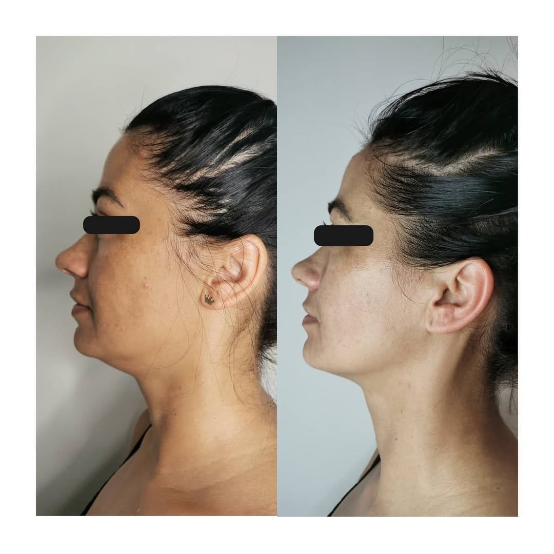 Post 10 by Ewelina Kulasik🤍KOBIDO• LIMFOMODELING•FACEMODELING🤍Kraków🤍 on Instagram (carousel)