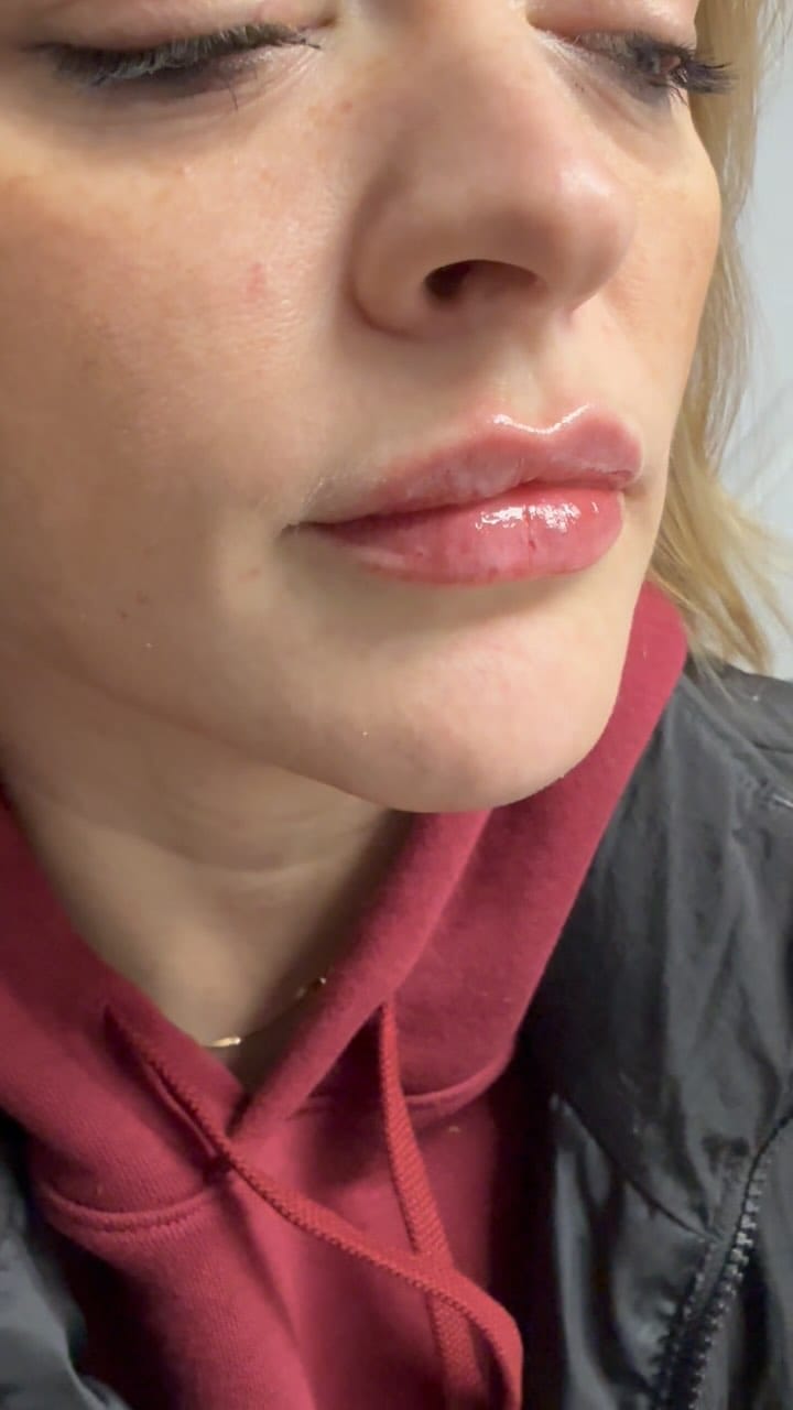 Post 8 by NYC🗽Botox | Fillers | PRP on Instagram (video)