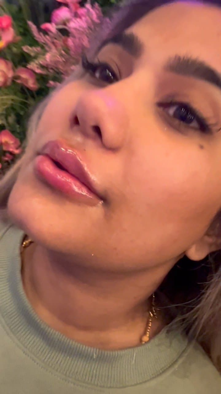 Post 9 by NYC🗽Botox | Fillers | PRP on Instagram (video)