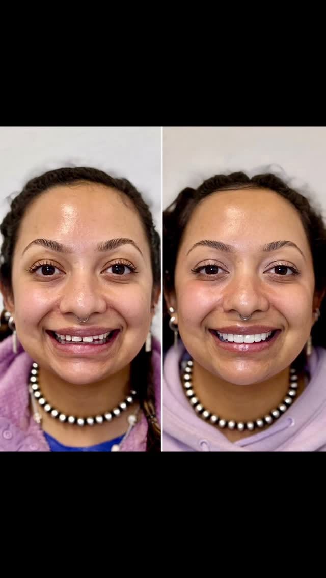 Post 4 by Nhu Dang, DDS, FICOI | Bella Dental Dallas on Instagram (video)