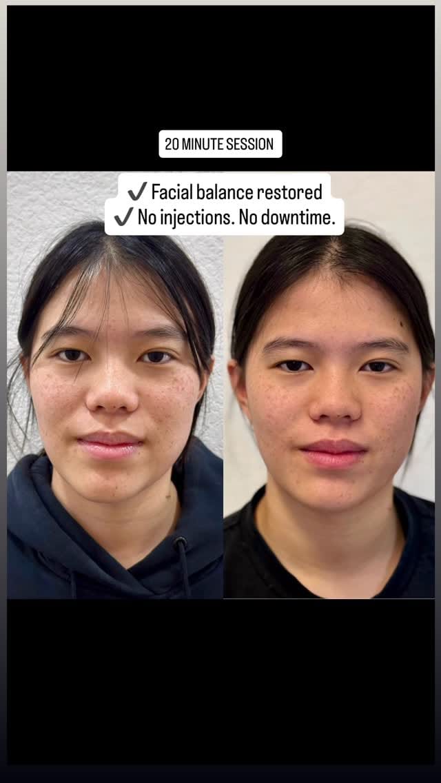 Post 1 by Nhu Dang, DDS, FICOI | Bella Dental Dallas on Instagram (video)