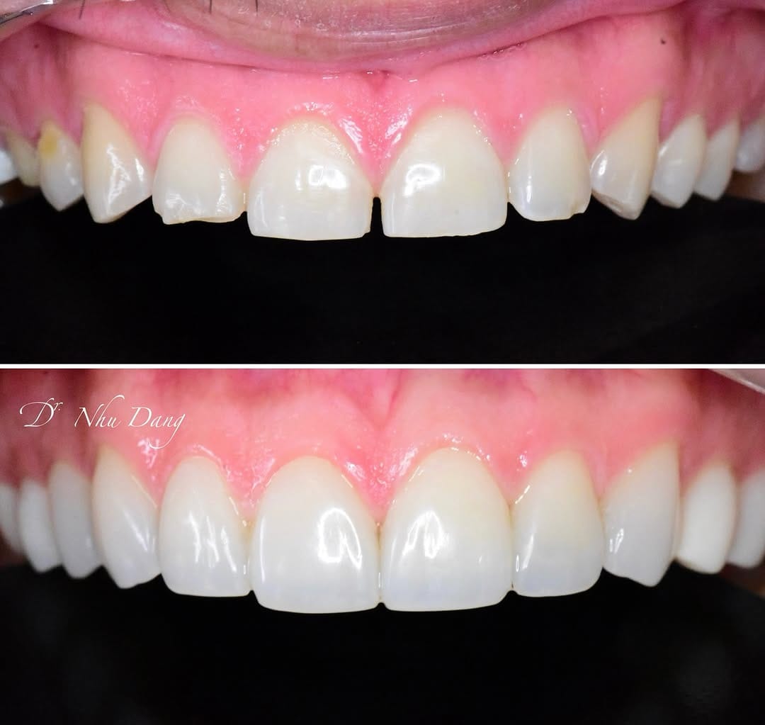 Post 8 by Nhu Dang, DDS, FICOI | Bella Dental Dallas on Instagram (image)