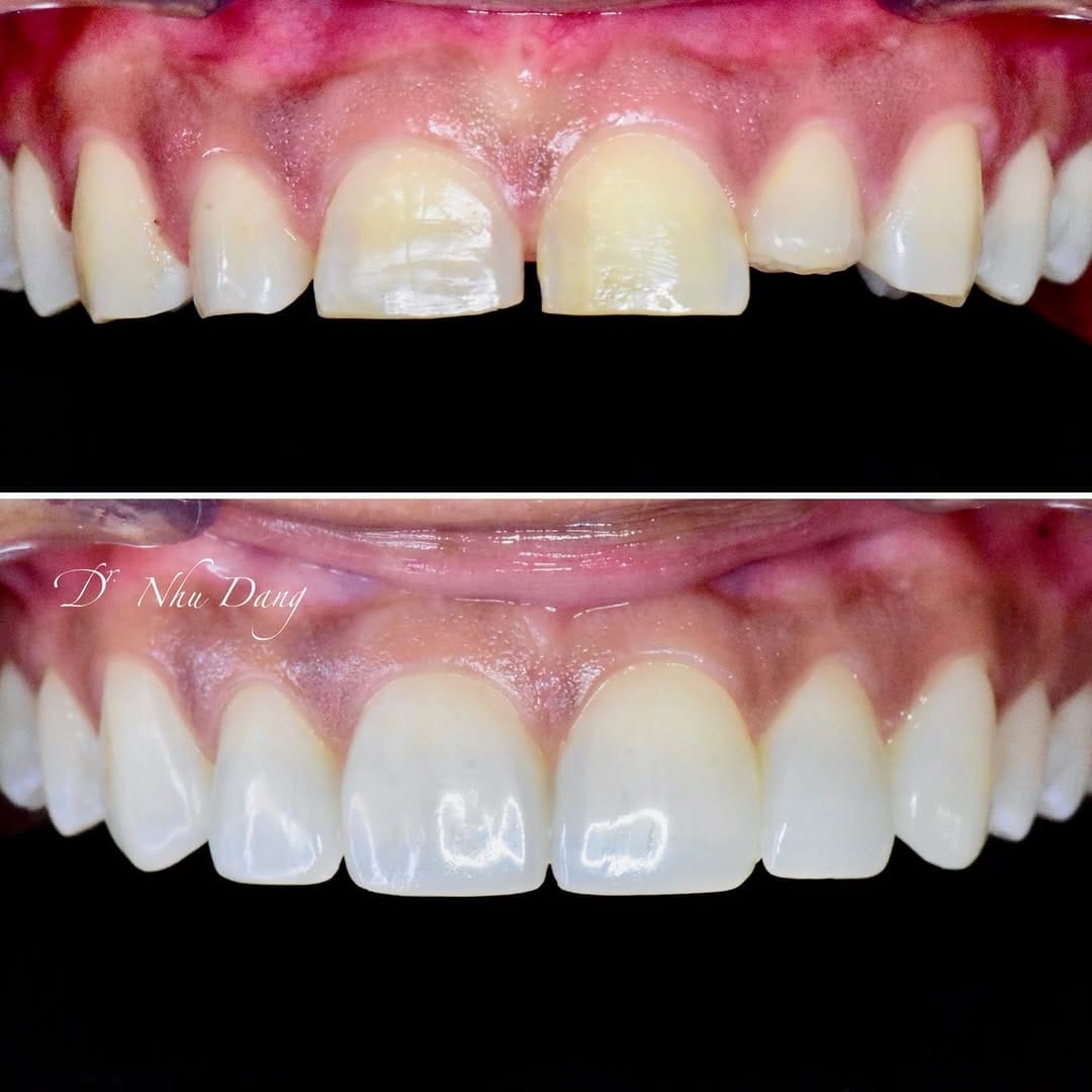 Post 5 by Nhu Dang, DDS, FICOI | Bella Dental Dallas on Instagram (image)