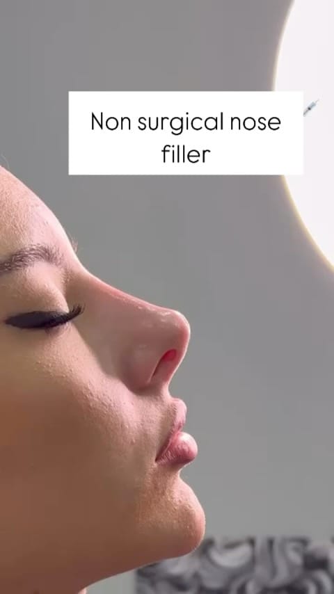 Post 5 by Botox + Filler + Nurse Injector | on Instagram (video)