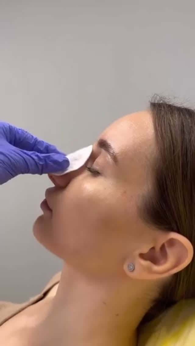 Post 1 by Botox + Filler + Nurse Injector | on Instagram (video)