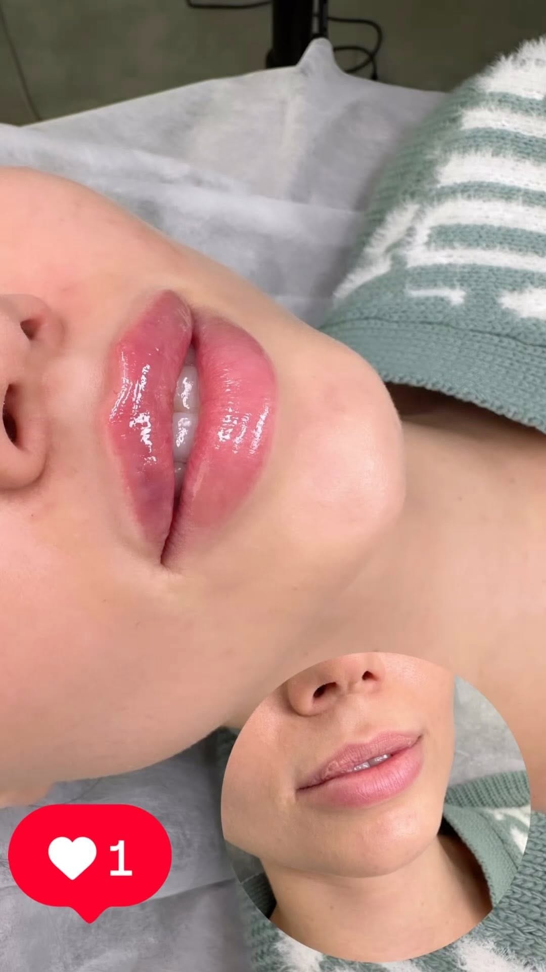 Post 7 by Botox + Filler + Nurse Injector | on Instagram (video)