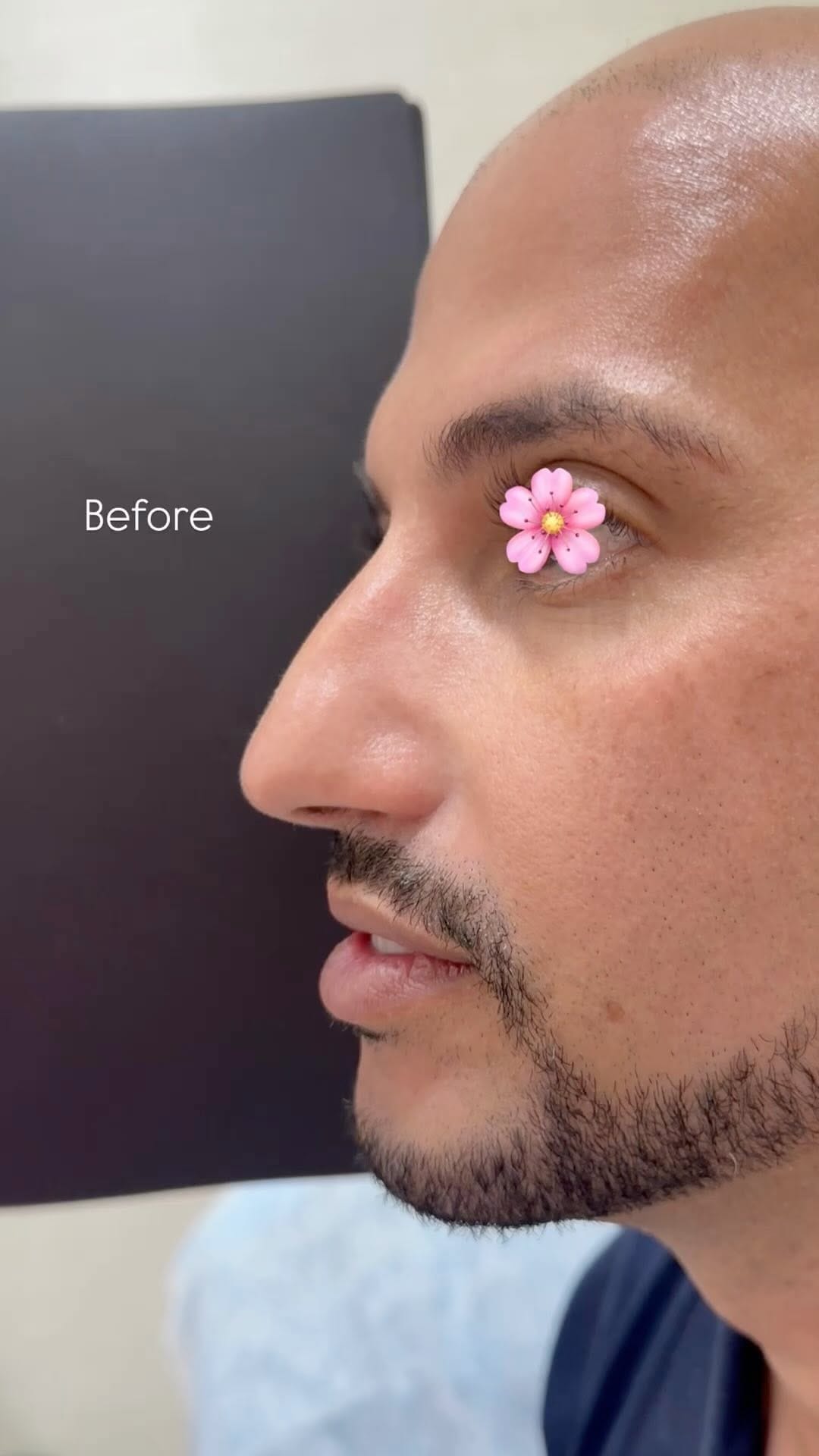 Post 6 by Botox + Filler + Nurse Injector | on Instagram (video)