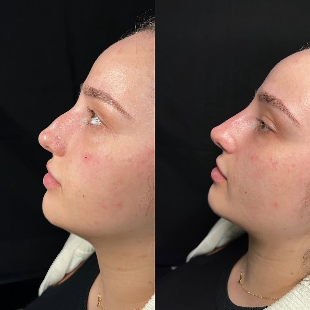 Post 4 by Botox + Filler + Nurse Injector | on Instagram (image)