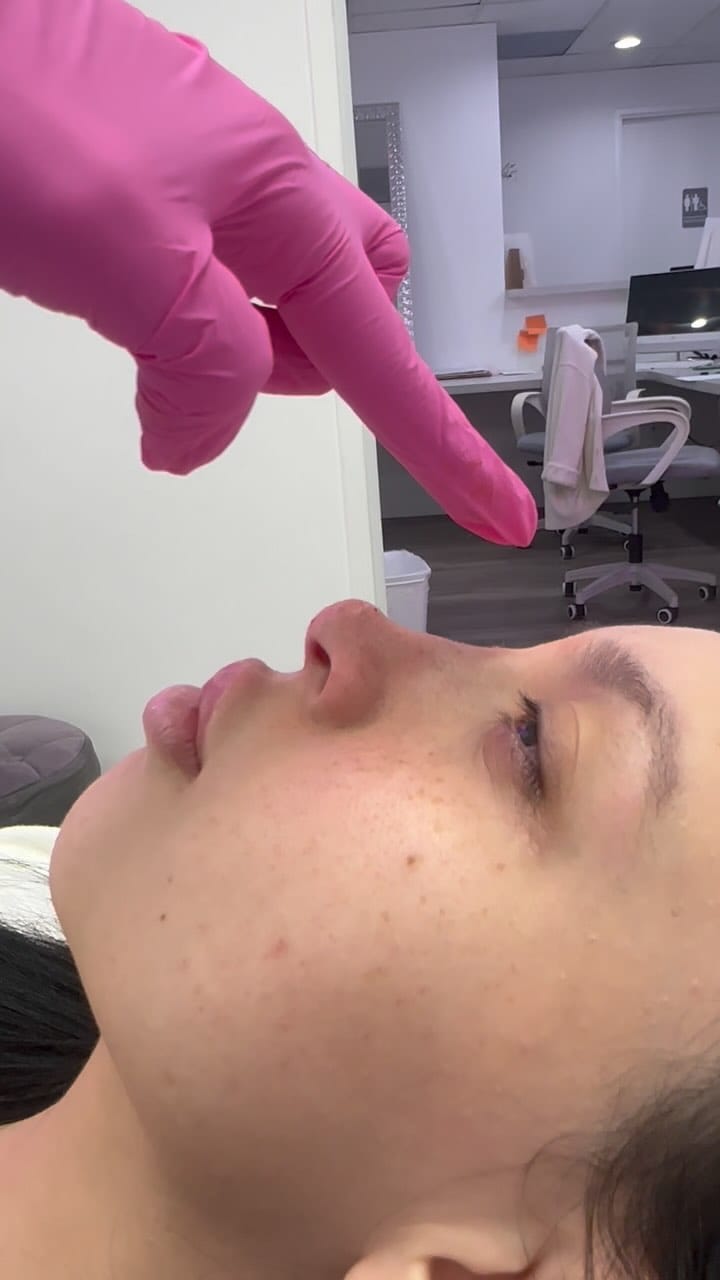 Post 3 by Botox + Filler + Nurse Injector | on Instagram (video)