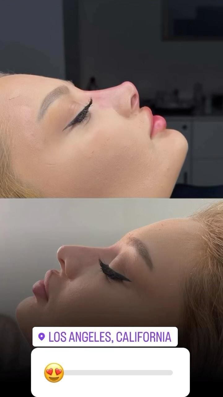 Post 9 by Botox + Filler + Nurse Injector | on Instagram (video)