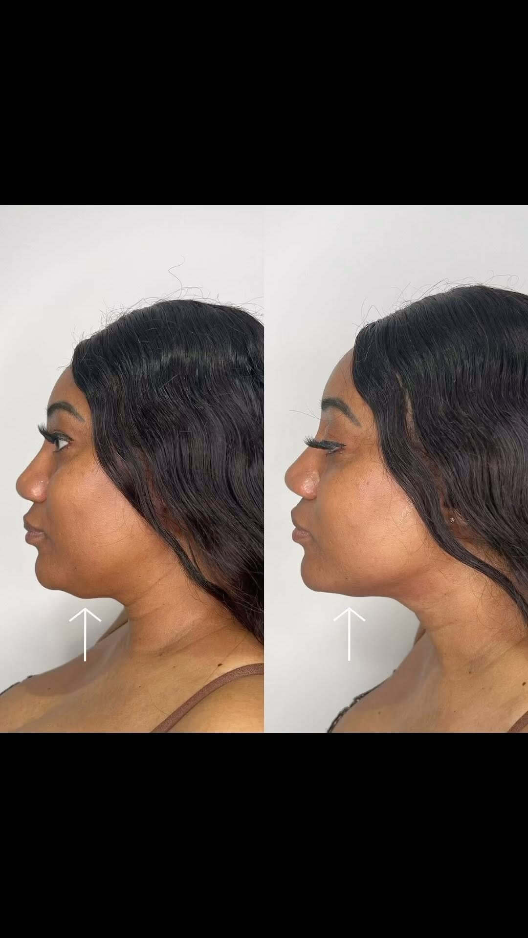 Post 8 by Botox + Filler + Nurse Injector | on Instagram (video)