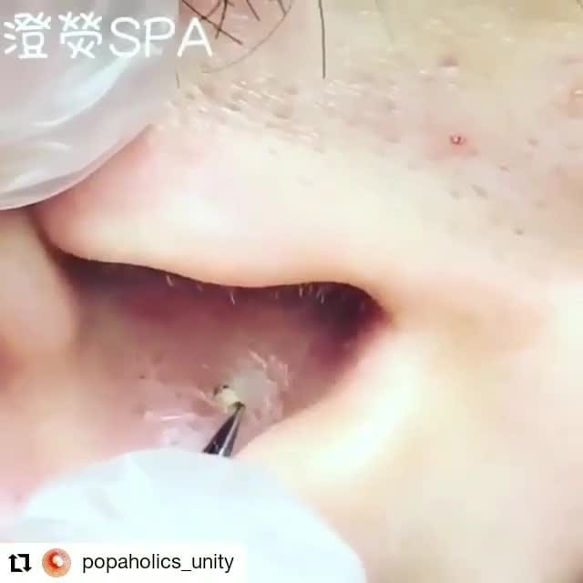 Post 6 by Pimple Poppers on Instagram (video)