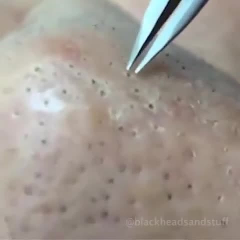Post 3 by Pimple Poppers on Instagram (video)