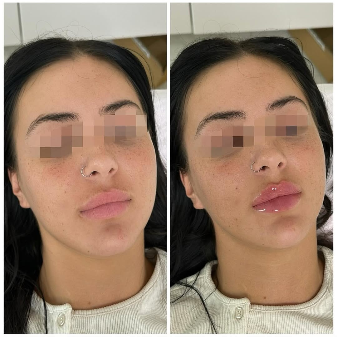 Post 6 by GLAM STUDIO CLINIC SURREY™ ♥ on Instagram (image)