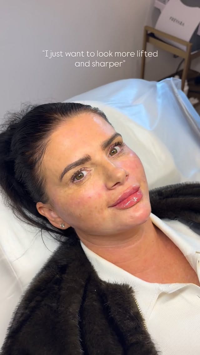 Post 8 by Abbey Marie | Filler | Facial Contouring | Skinboosters on Instagram (video)