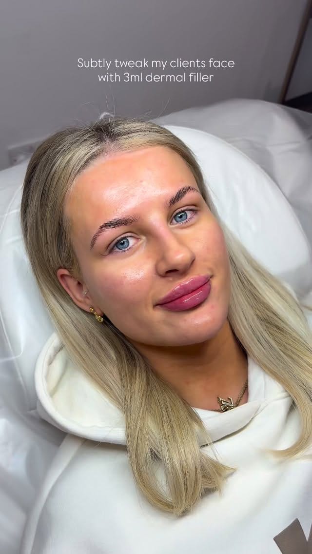 Post 3 by Abbey Marie | Filler | Facial Contouring | Skinboosters on Instagram (video)