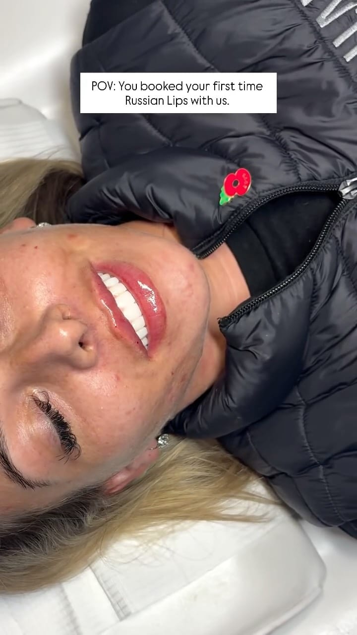 Post 9 by Abbey Marie | Filler | Facial Contouring | Skinboosters on Instagram (video)