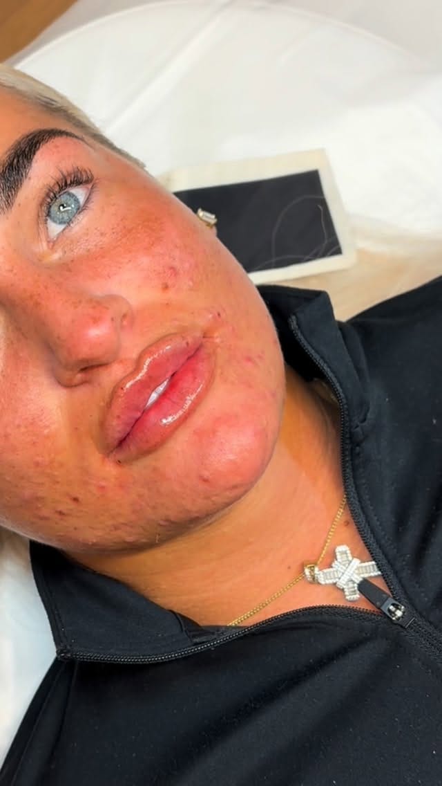 Post 6 by Abbey Marie | Filler | Facial Contouring | Skinboosters on Instagram (video)