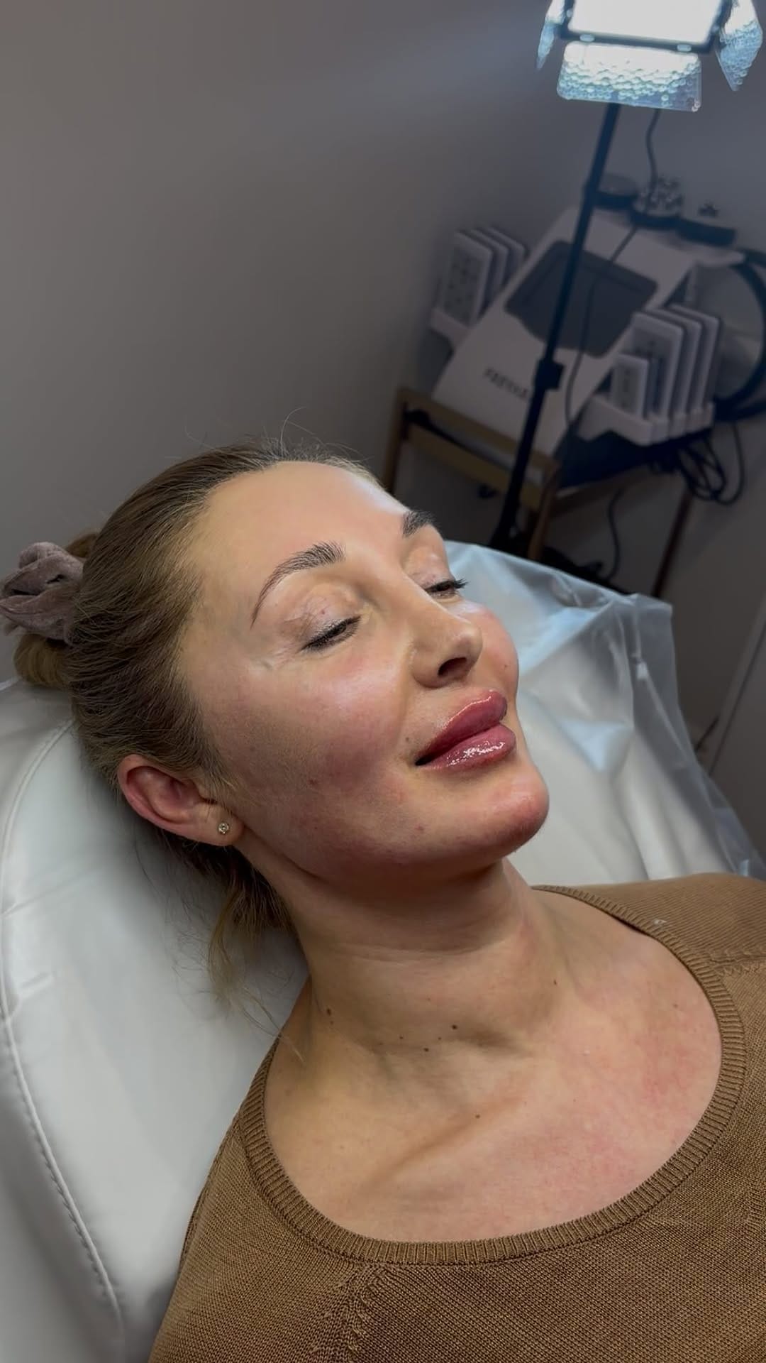 Post 7 by Abbey Marie | Filler | Facial Contouring | Skinboosters on Instagram (video)