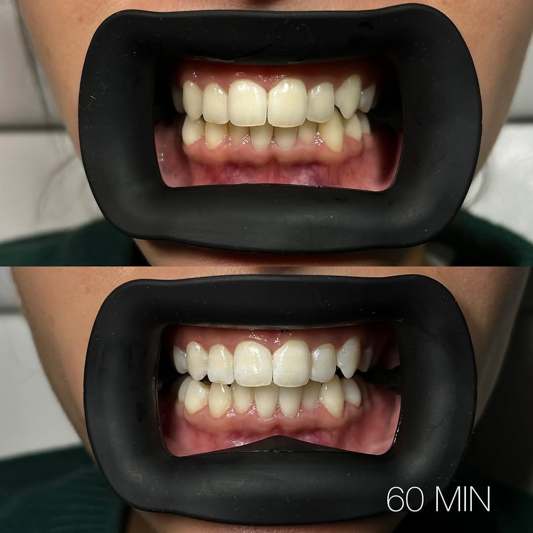Post 7 by B.T.M | LONDON TOOTH GEMS | TEETH WHITENING | GRILLZ on Instagram (image)