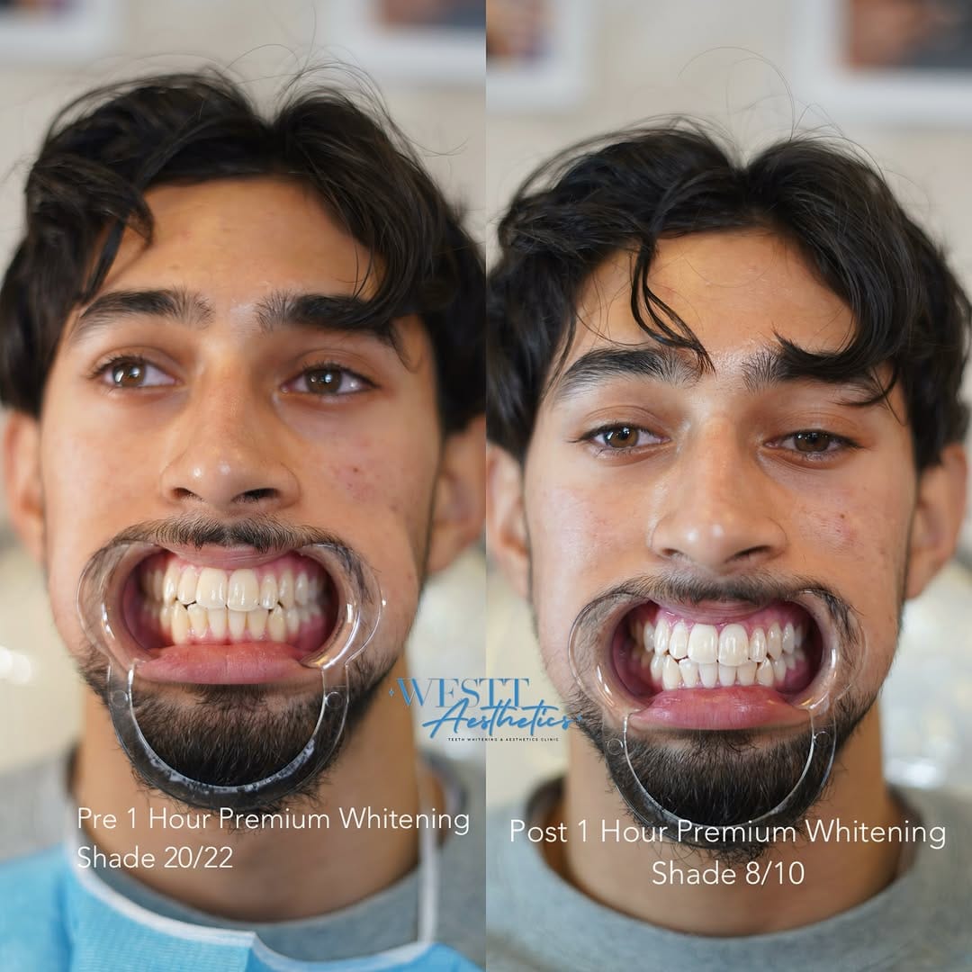 Post 1 by #1 TEETH WHITENING | SUPPLIES | FACIALS on Instagram (image)