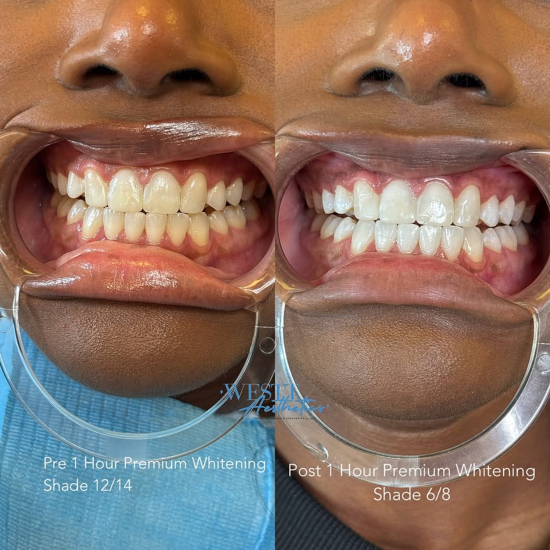 Post 4 by #1 TEETH WHITENING | SUPPLIES | FACIALS on Instagram (image)