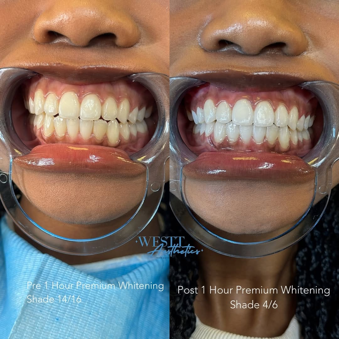 Post 7 by #1 TEETH WHITENING | SUPPLIES | FACIALS on Instagram (image)
