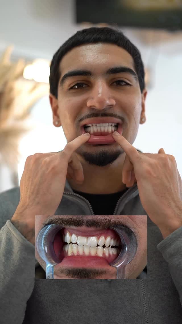 Post 3 by #1 TEETH WHITENING | SUPPLIES | FACIALS on Instagram (video)