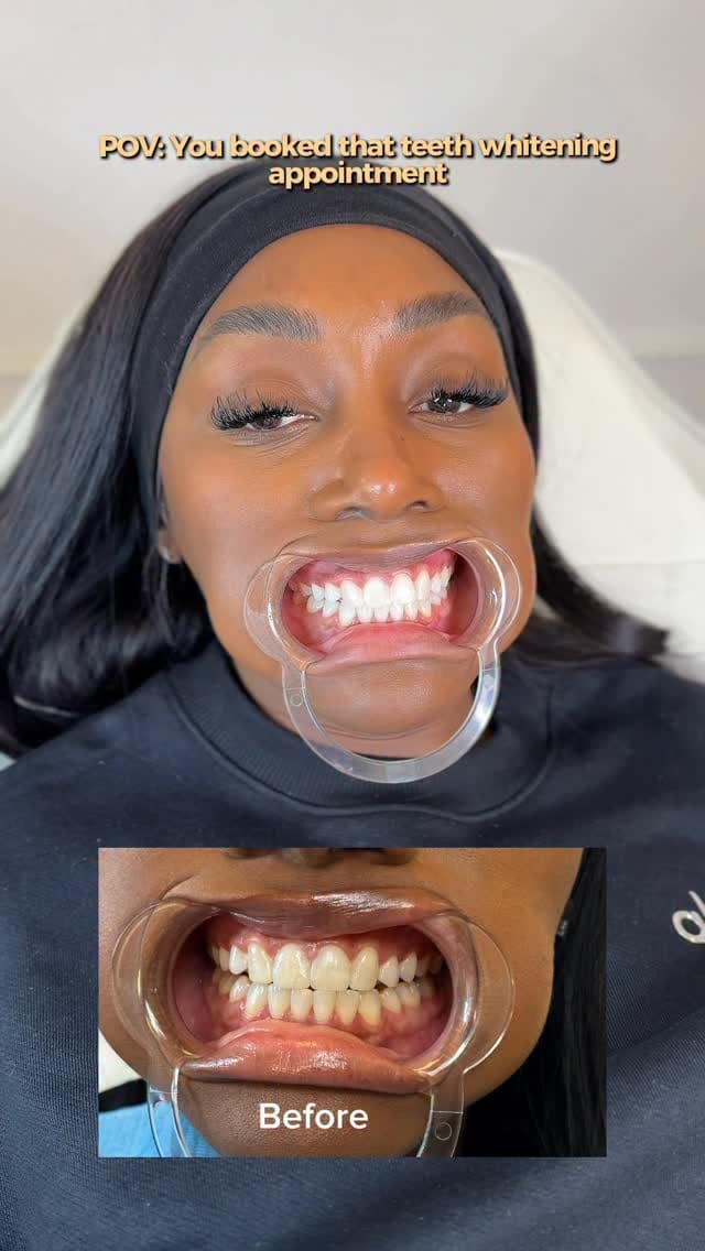 Post 6 by #1 TEETH WHITENING | SUPPLIES | FACIALS on Instagram (video)