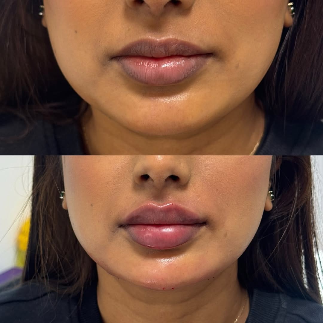 Post 7 by Inara Babamir | Piercer & Cosmetic Injector on Instagram (image)